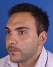 After Hair Transplant&nbsp;Front